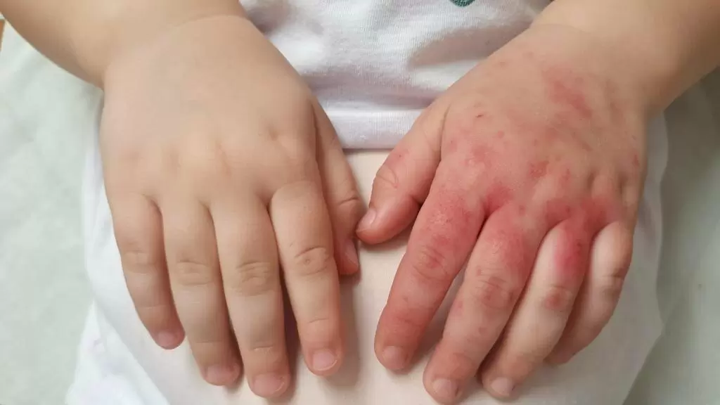 Аллергия как проявление внутреннего конфликта